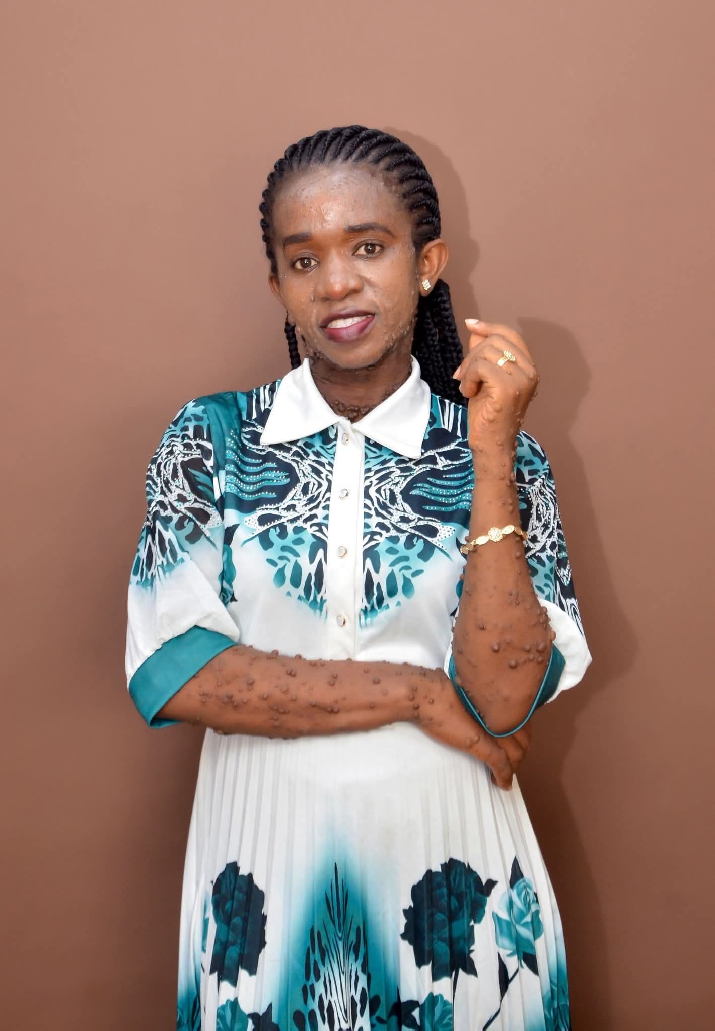 Nigerian Woman Says Churchgoers Avoid Her Handshake Over Neurofibromatosis